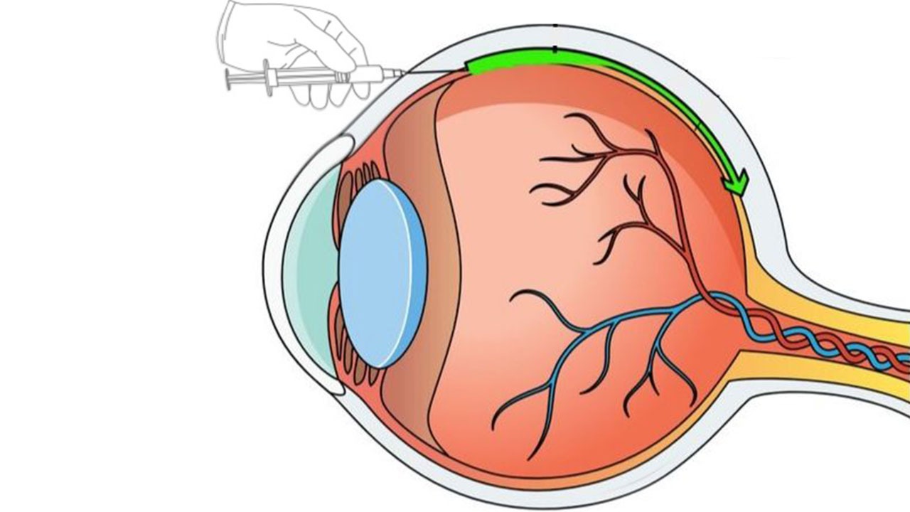 درمان بیماری های چشمی با طراحی نانوذرات حامل ژن