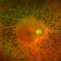 نانوبادی‌ها یک نوع بیماری چشم را درمان می کند